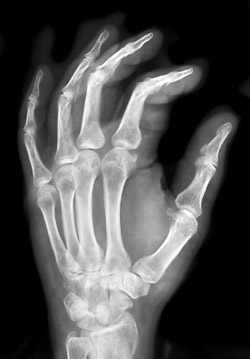 Hand X-Ray